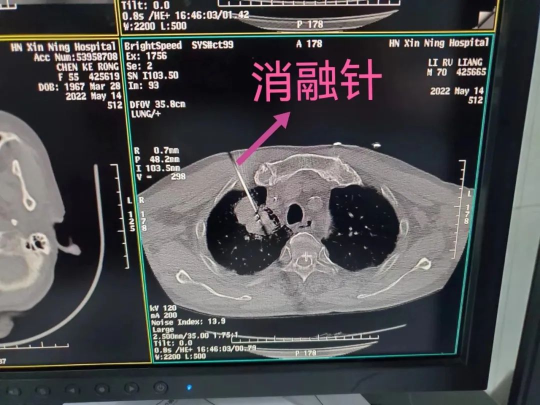 让癌细胞精准灭活——我院成熟开展CT引导下肿瘤微波消融术