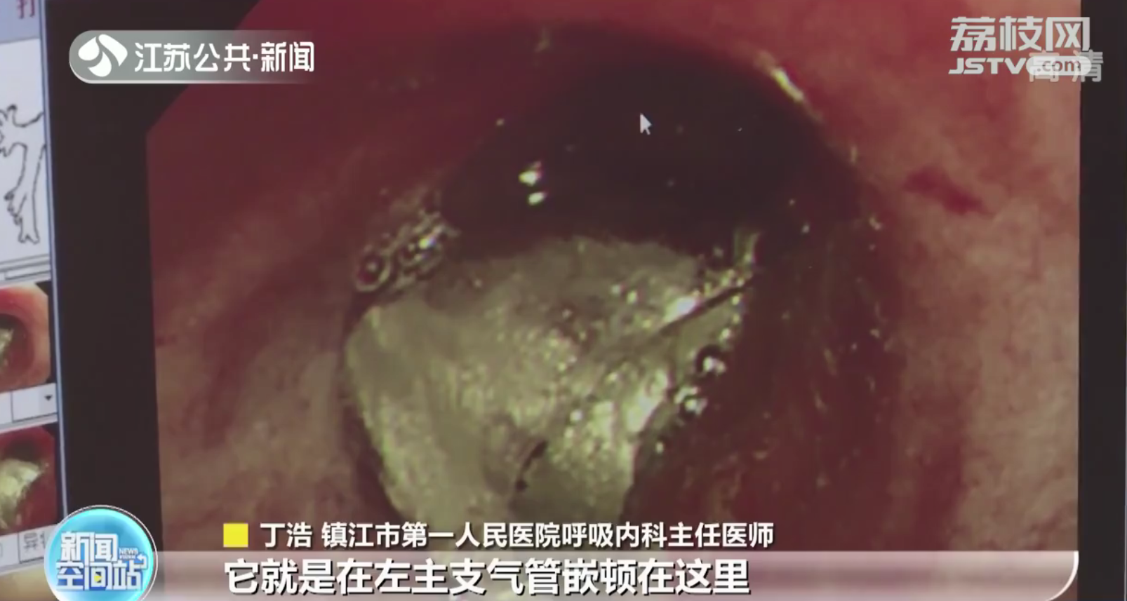 镇江大爷假牙掉入气管 医生巧妙拽出