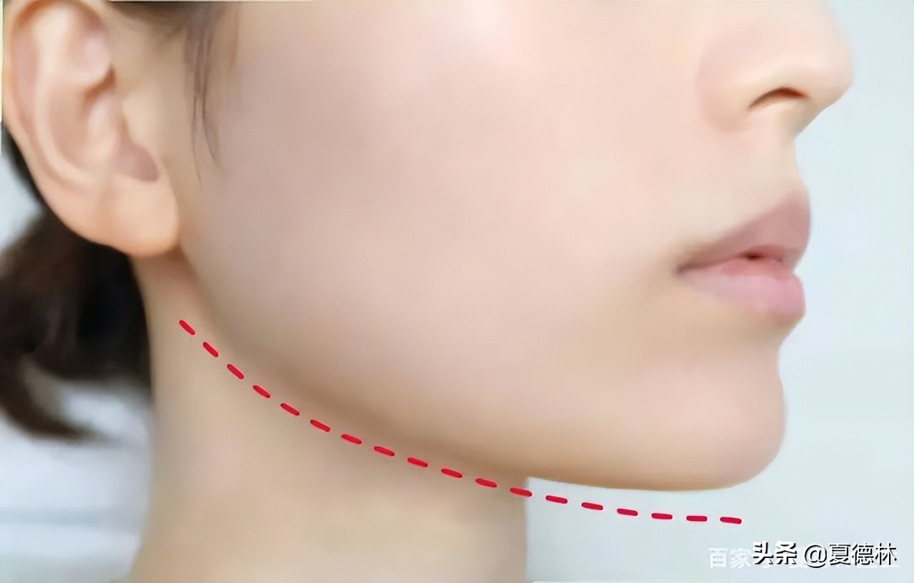 更符合人类的美学标准,让人看起来跟自然,媲美"妈生款"下颌角