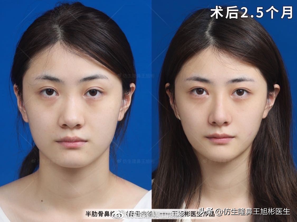67鼻梁基底部也就是鼻骨宽,鼻骨与脸部的分界不清,糊成一片,也因而