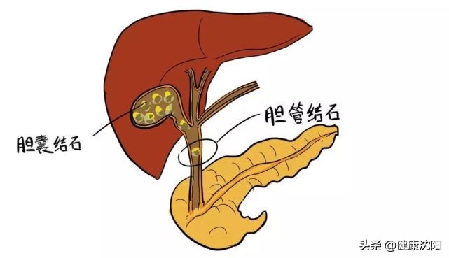 把健康带回家 | 得了胆囊结石怎么办？