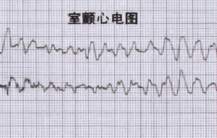 女大学生跑两百米猝死，医生提醒：运动之前，一定要注意这些情况