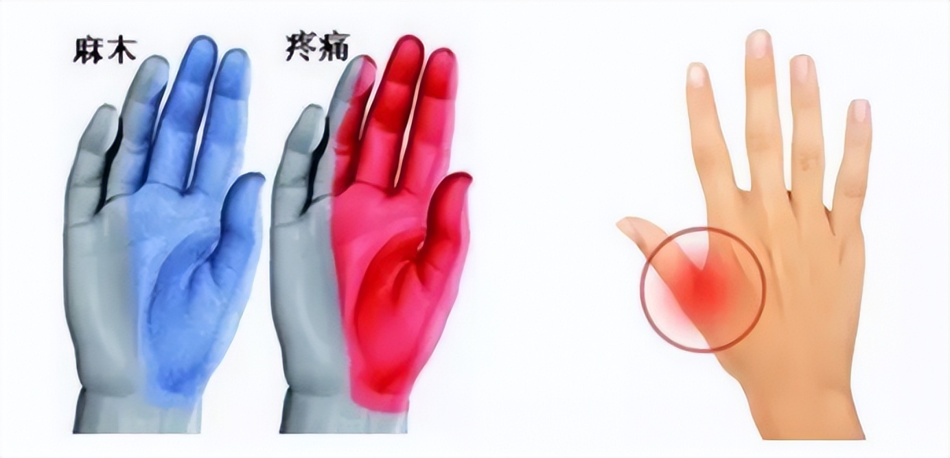 手指一动就疼,还有响声,医生却说:问题不在手指上!真凶藏在哪