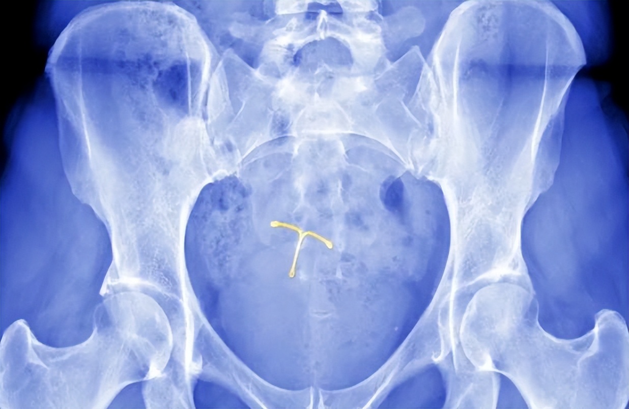 爱母环可以放多少年(节育环不取出) - 青木春