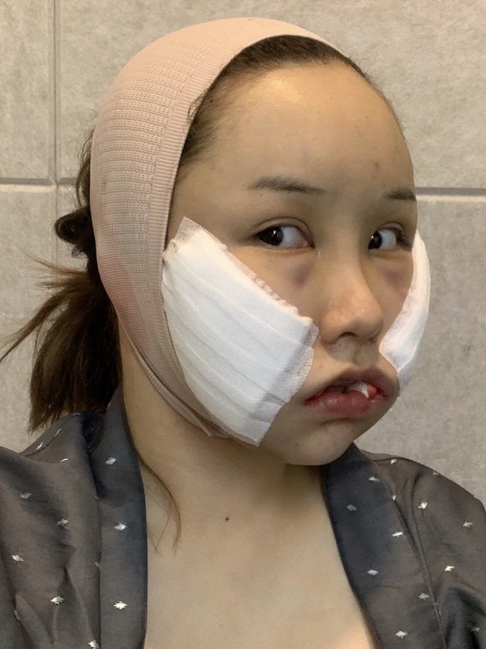 34岁小姐姐做了面部吸脂后,闺蜜以为我换了一张脸