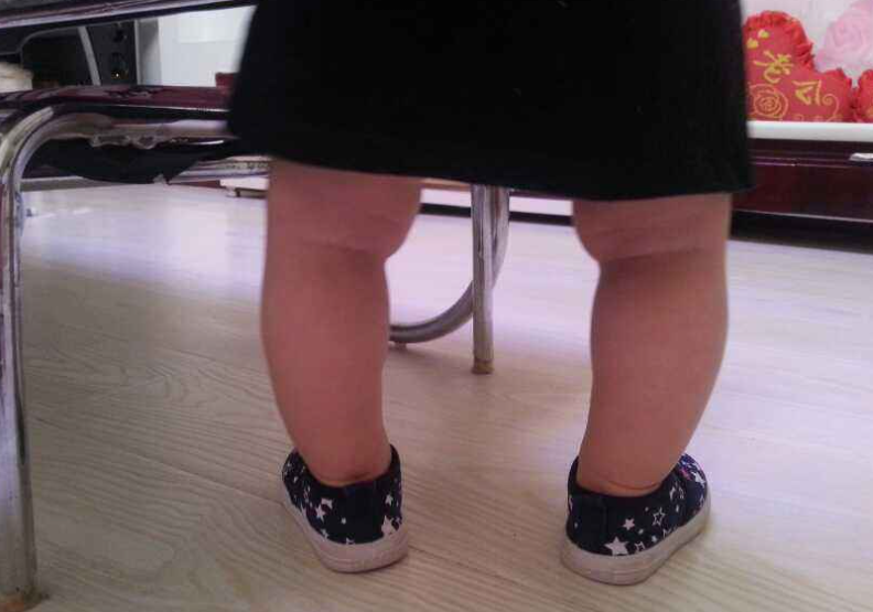 大长腿夫妻的孩子腿型也存在不完美的情况,这就说明除了遗传影响之外