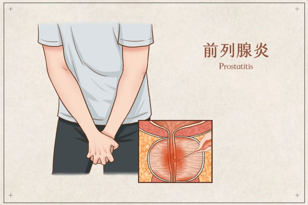 前列腺是“生命腺”，预防前列腺炎，只需要做到四件小事