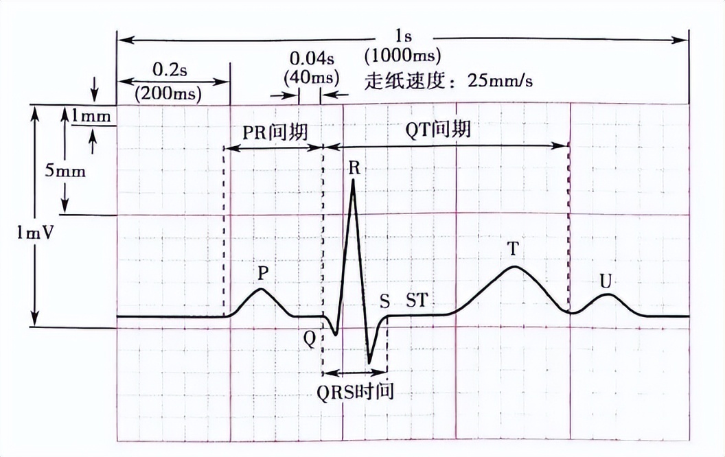 心电图检查正常,出院几天后离世!原因为何?