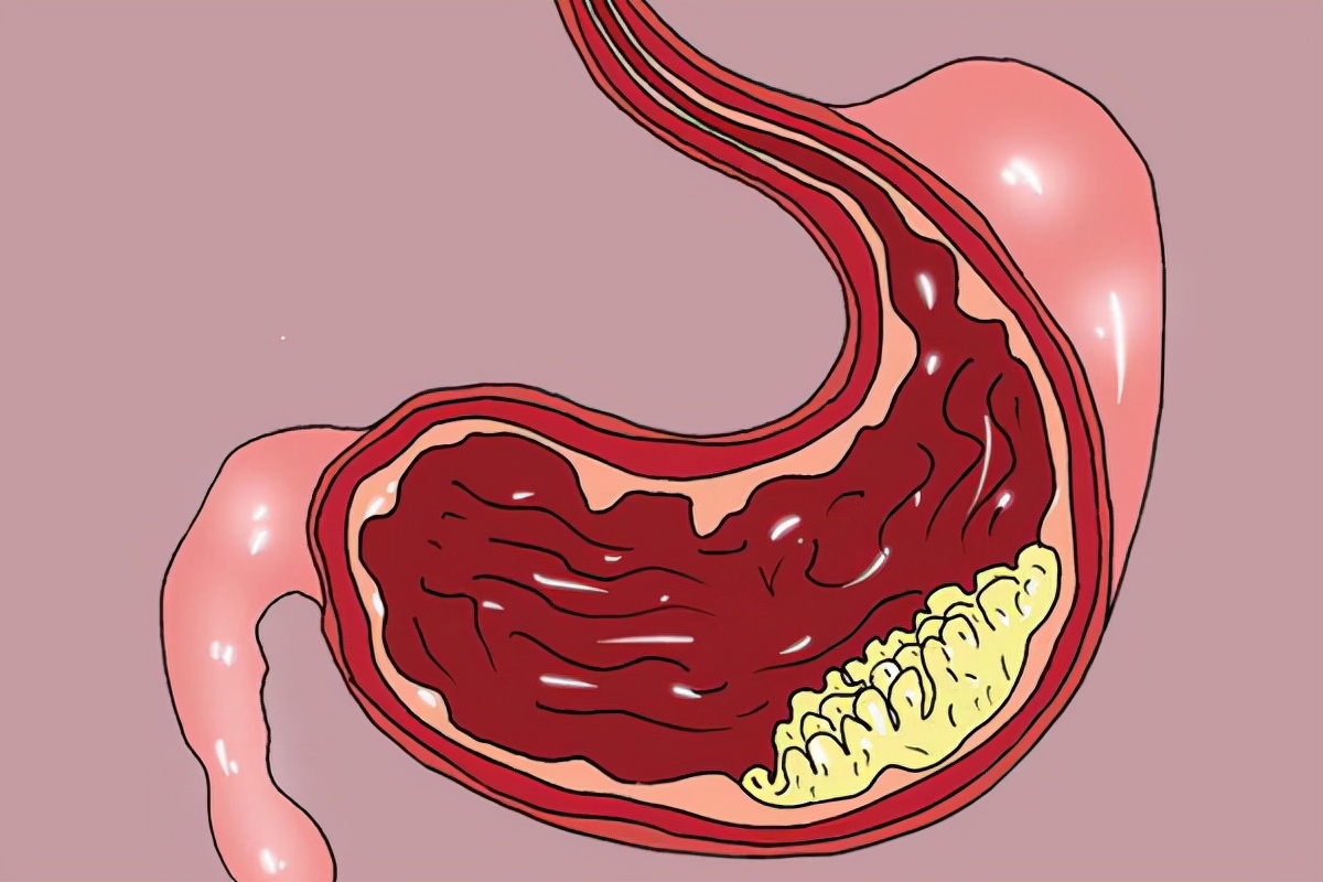 从胃炎到胃癌，需要几年？消化科医生说出实话，不妨查看一下