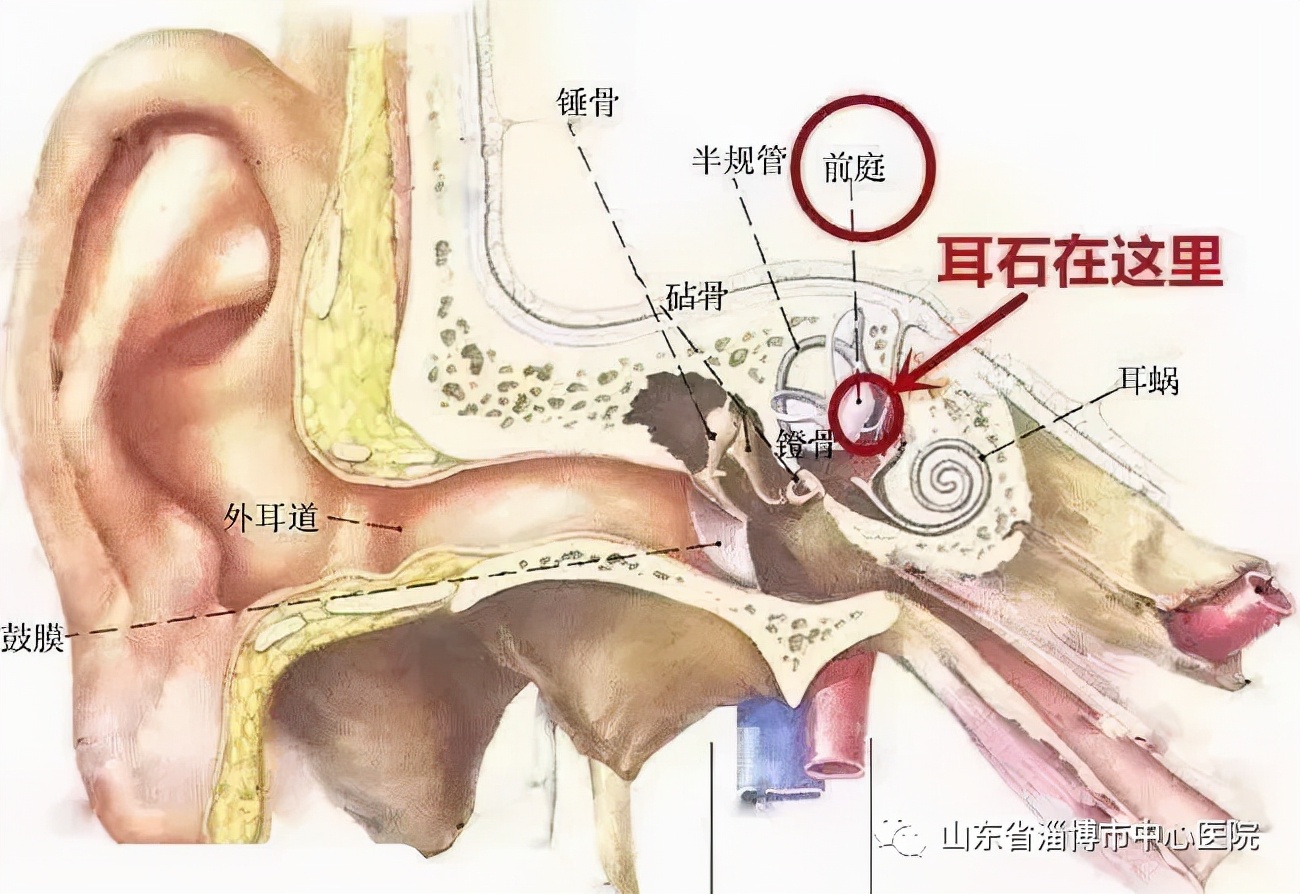 “疯狂的石头”——市中心医院耳科帮您了解耳石症