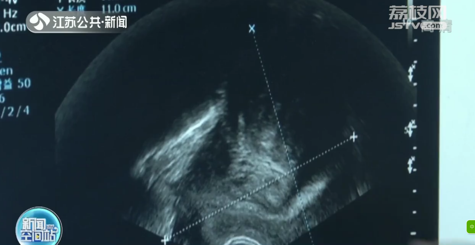 南京：女子体内现巨大子宫肌瘤 肚大如怀孕四五个月
