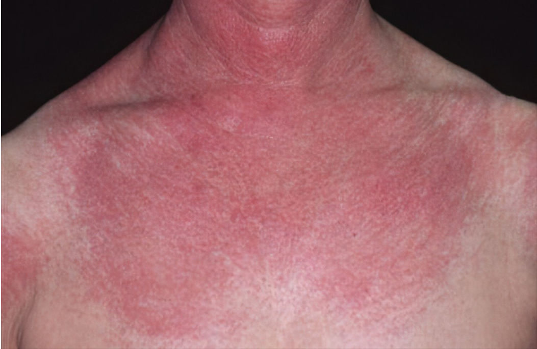 提醒:皮肤出现4种异常,或是癌症信号