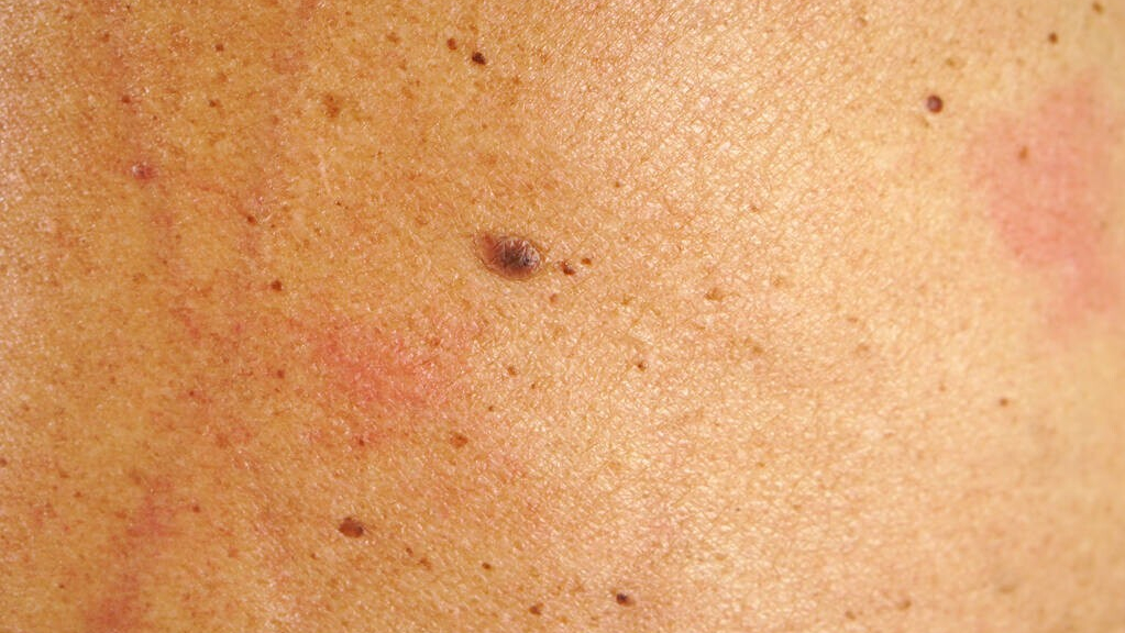 黑斑,脸上长黑点,是皮肤癌吗?医生提醒:这3种异样要警惕