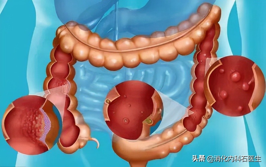 老年腹痛消瘦1年，以为怪病被关进棺材，腹部奇怪声音露出端倪