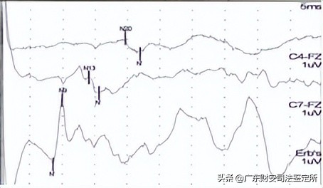 司法鉴定所对高坠伤致头面部损伤的法医临床鉴定