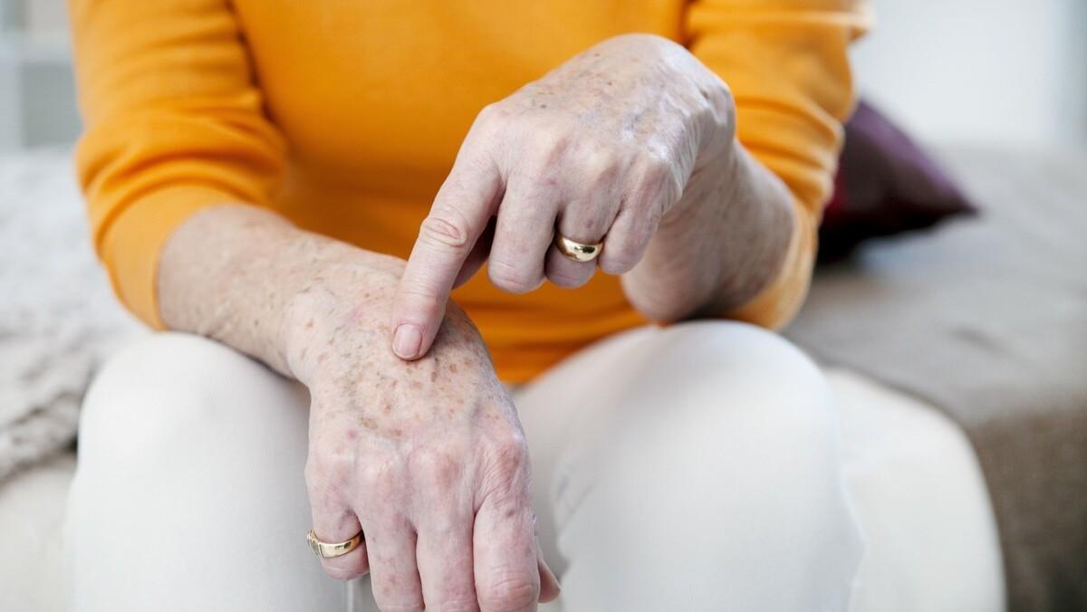【为什么会长老人斑？红霉素软膏能去除老人斑？老年斑要不要治疗？】图1
