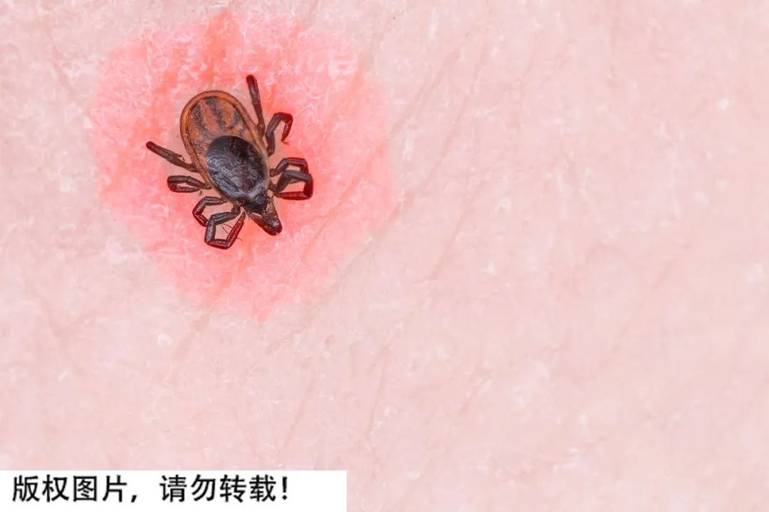 小小的蜱虫，为何能致人死亡？被咬后该如何处理？