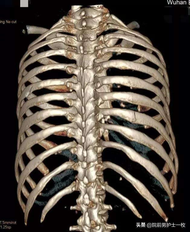 人体有多少根肋骨(多发肋骨骨折的处置措施) - 青木春