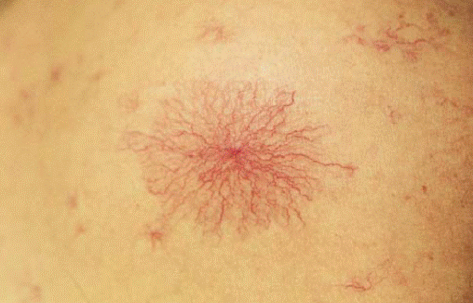 有蜘蛛痣就是有肝病了?数量多颜色深是病情加重?如何才能消失?