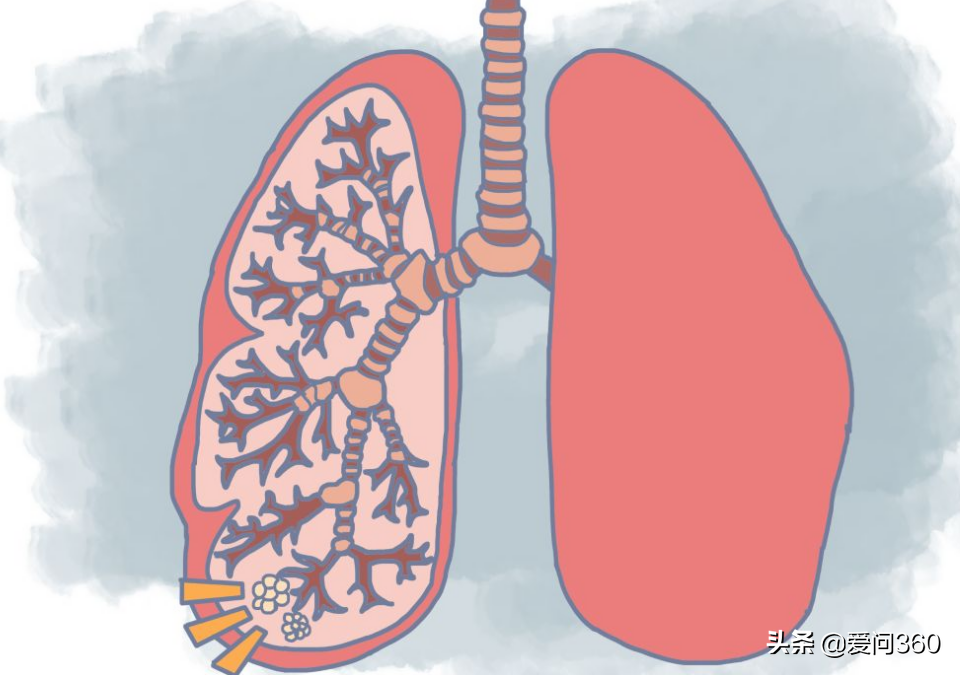 肺结节到底什么原因引发的？了解几个产生的原因，提前避免和预防