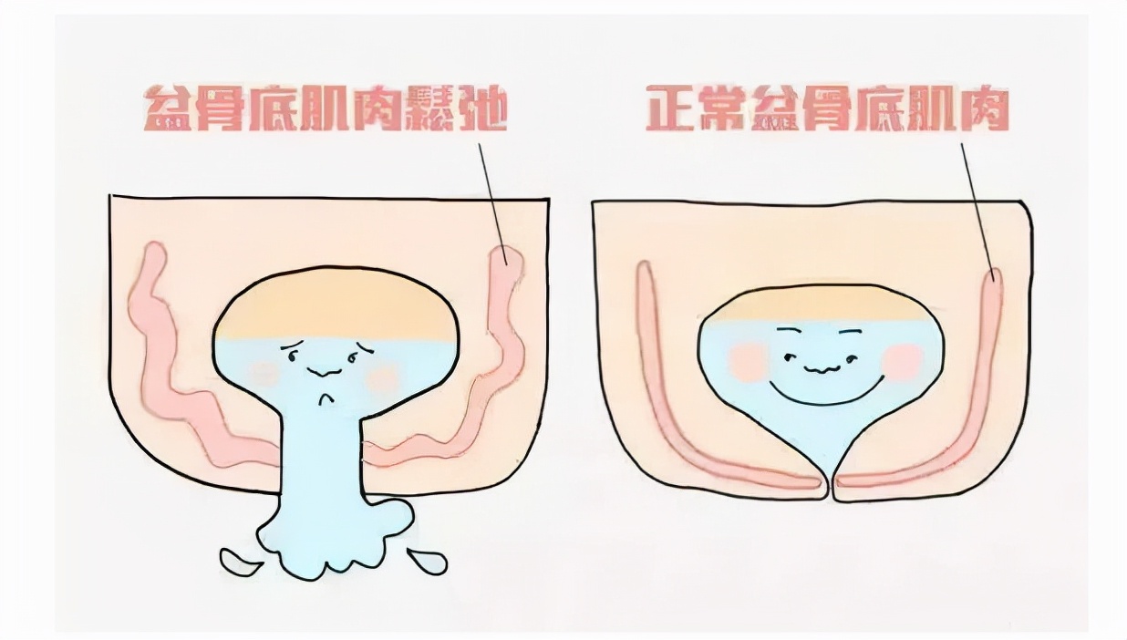 今年“三八”不收礼，收礼只收盆底肌治疗套餐！专家告诉你原因