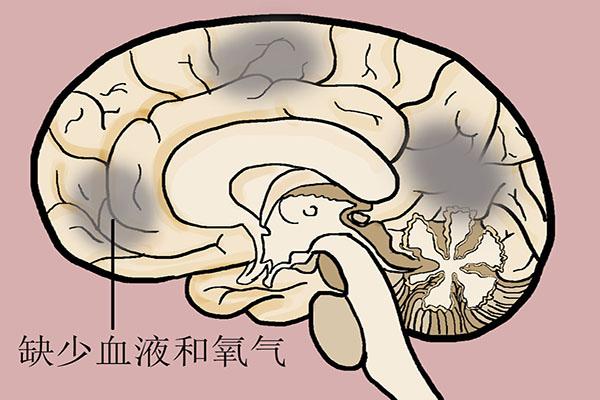 为什么脑梗更加“偏爱”黑夜？脑梗前可能会有3种症状，别忽视