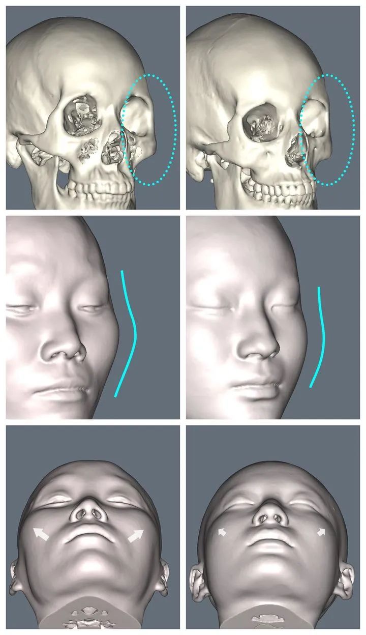 不同的颧骨形态类型，哪些需要改善