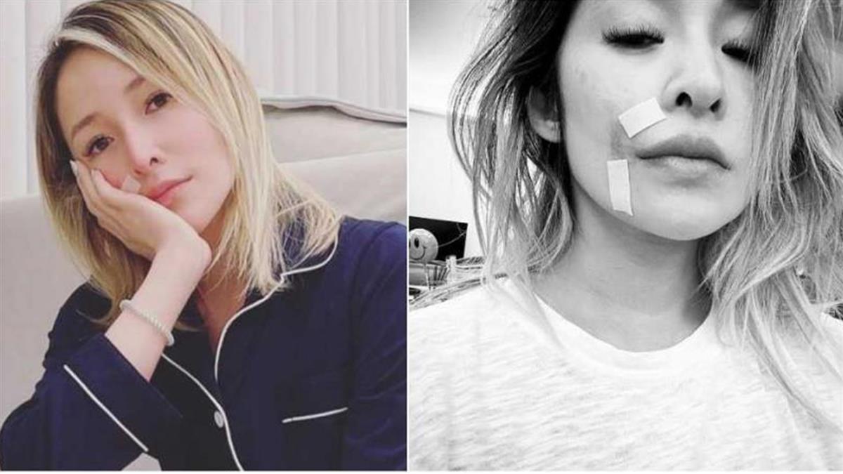 萧亚轩宣告正式复出，脸上被爱犬咬伤的伤疤清晰可见