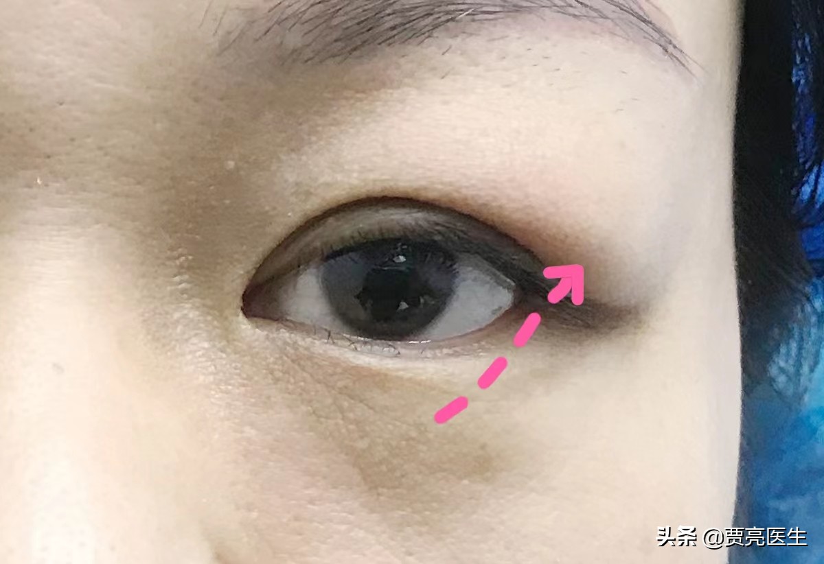肿泡眼和泪腺脱垂的区别-泪腺脱垂和泪腺肿瘤区别 - 情书号