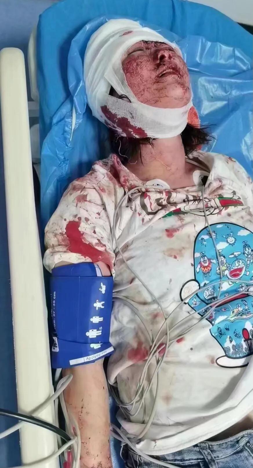 被打女孩已脱离生命危险，警方：正在追缉，严惩行凶者
