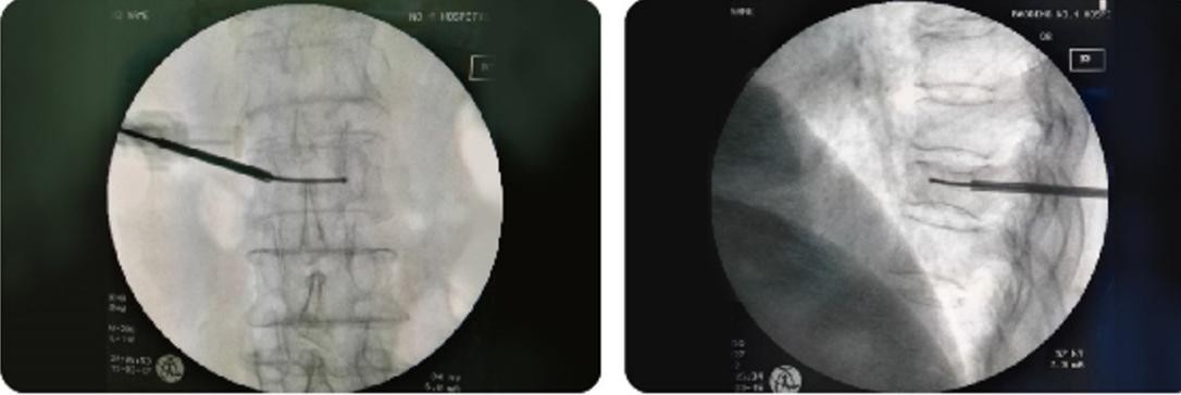 金堂县二医院骨科成功开展县内首例经皮穿刺弯角椎体成形手术