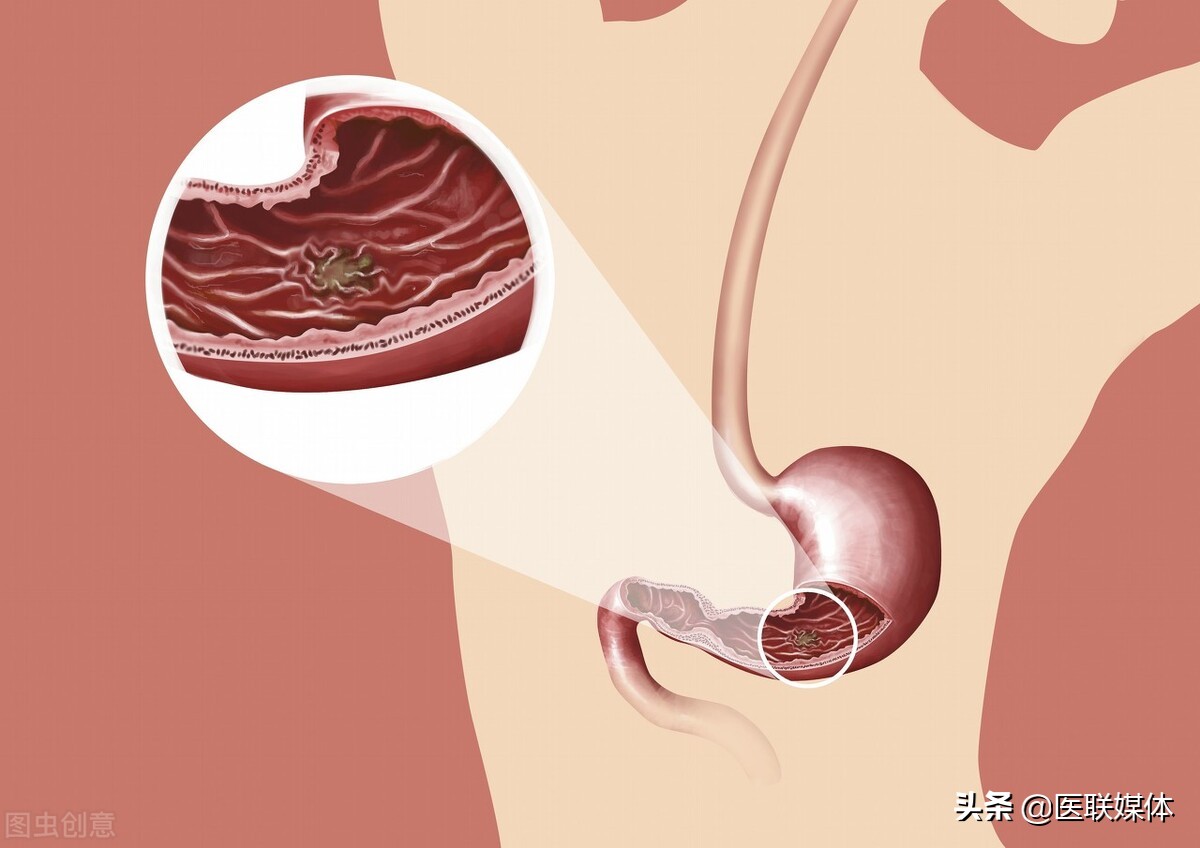 查出胃溃疡怎么办？给出5个护理小建议，长期坚持帮助愈合