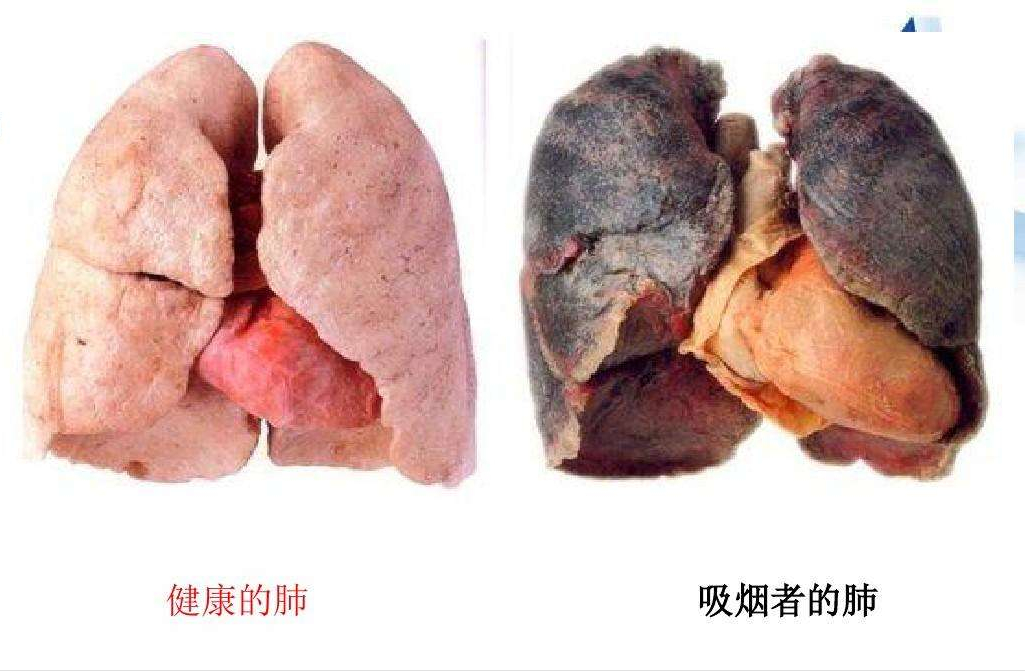 吸烟前后肺部对比照片图片