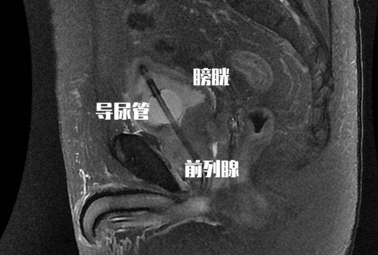 前列腺增生PSA指标异常时，为什么医生让我做磁共振？目的是什么