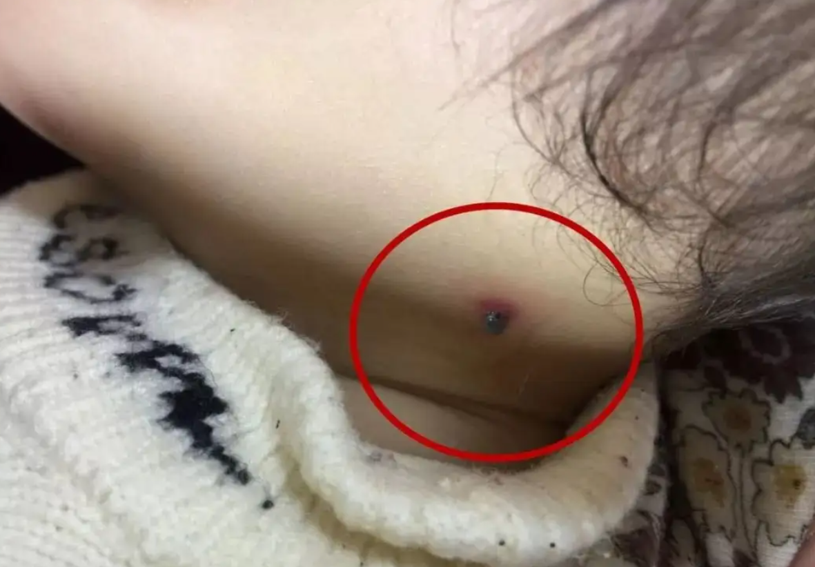 4岁孩子被蜱虫咬,妈妈"4步法"处理显智慧,医生:回家观察就行