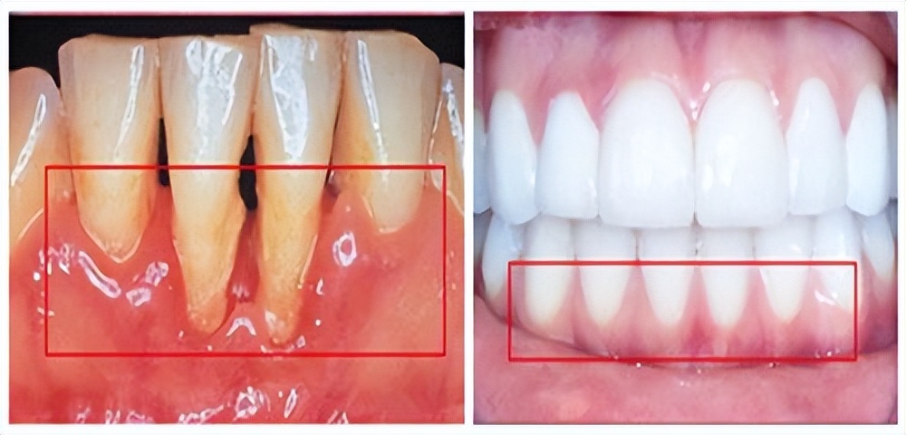 牙根外露怎麼解決?老專家告訴你最正確的做法