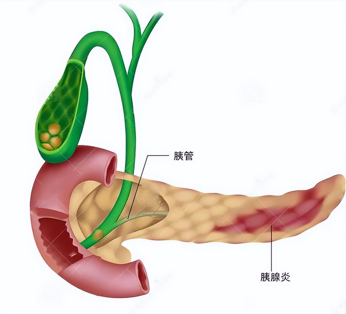 醫生提醒:保護胰腺,需要注意這4點