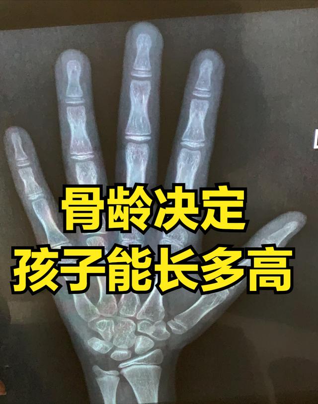 测骨龄是制造焦虑?很多家长不清楚它的意义,但孩子已在关注了