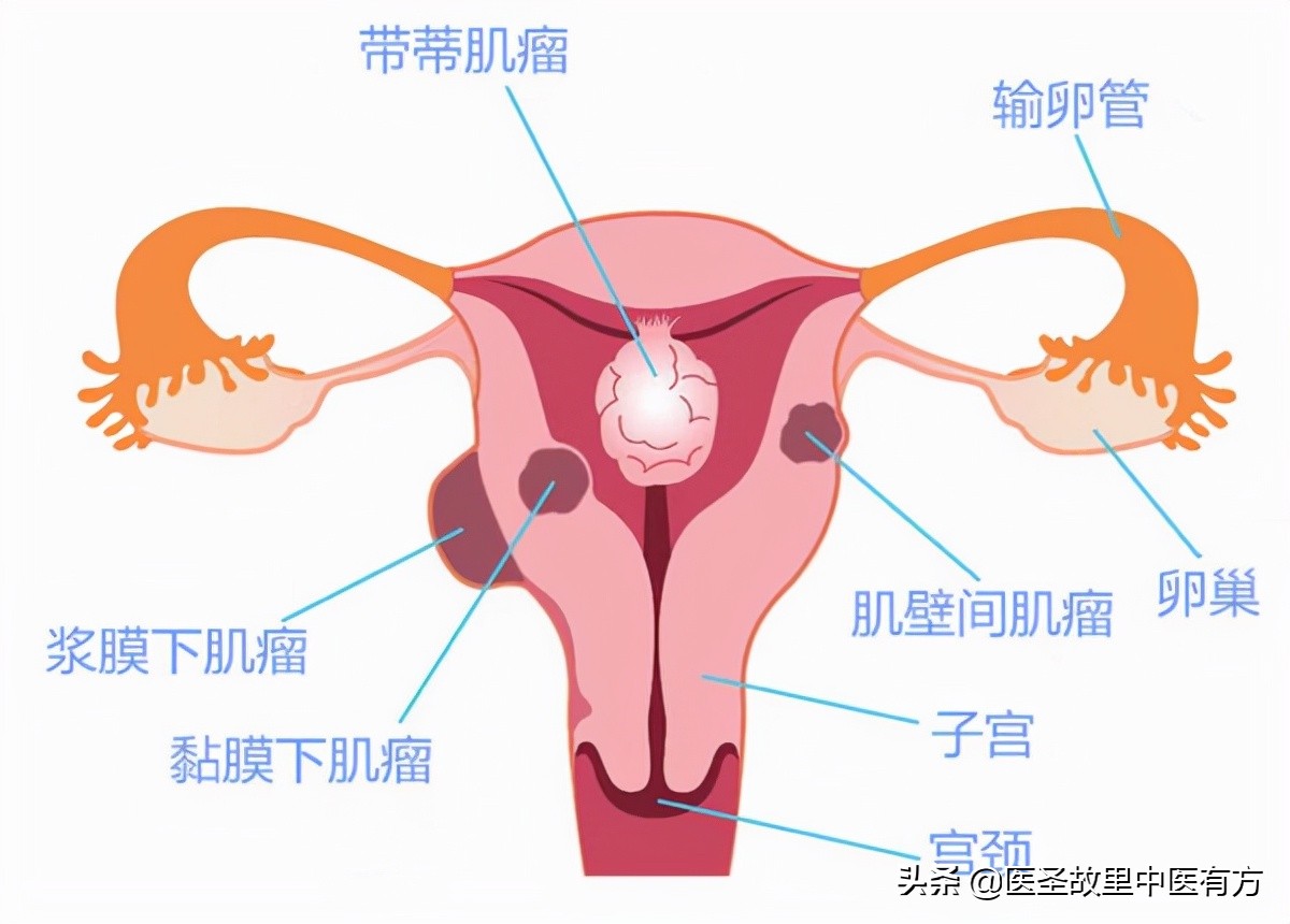 活血化瘀第一名方——桂枝茯苓丸，结节、包块、肌瘤、囊肿皆能消