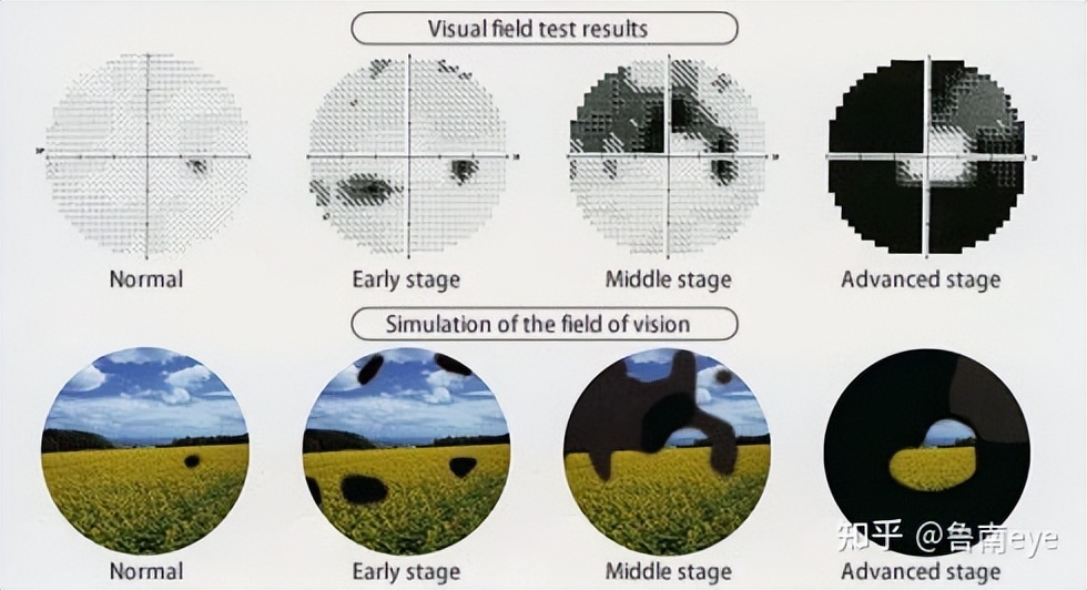 仁医科普丨绿光，青光眼患者的警示之光