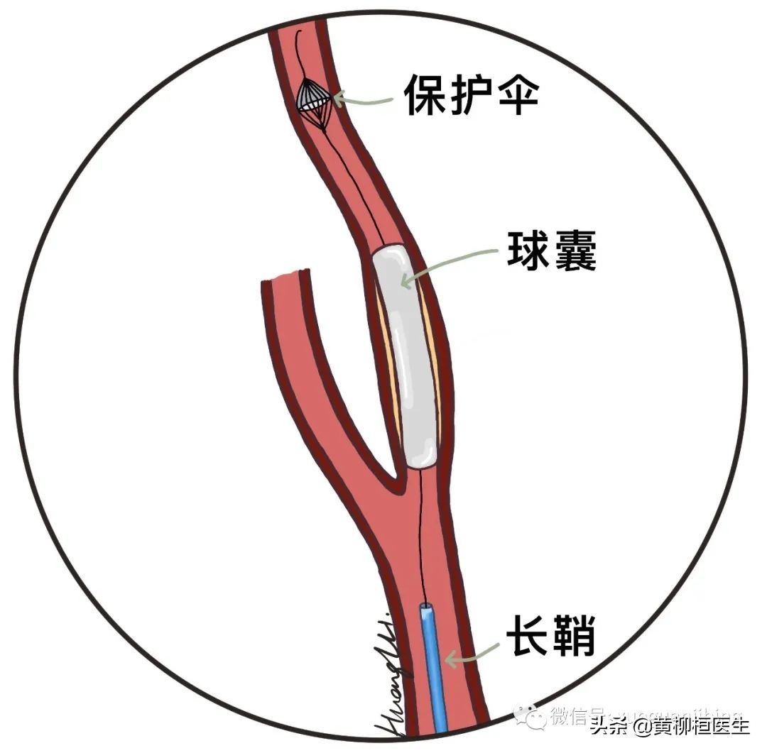 颈动脉支架手术原来是这么做