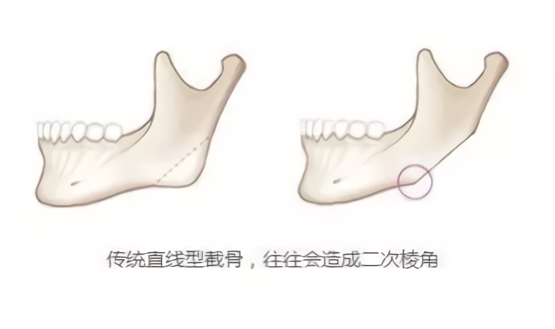 那些“一刀切”削脸的明星还好吗？有的已垮掉，小方脸成最后赢家