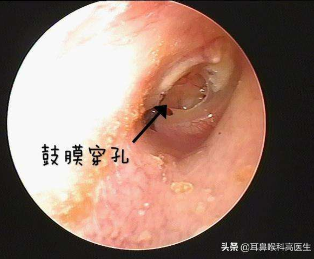 【爱耳日系列科普之耵聍】耳朵耳屎不要随便掏，小心掏出鼓膜穿孔