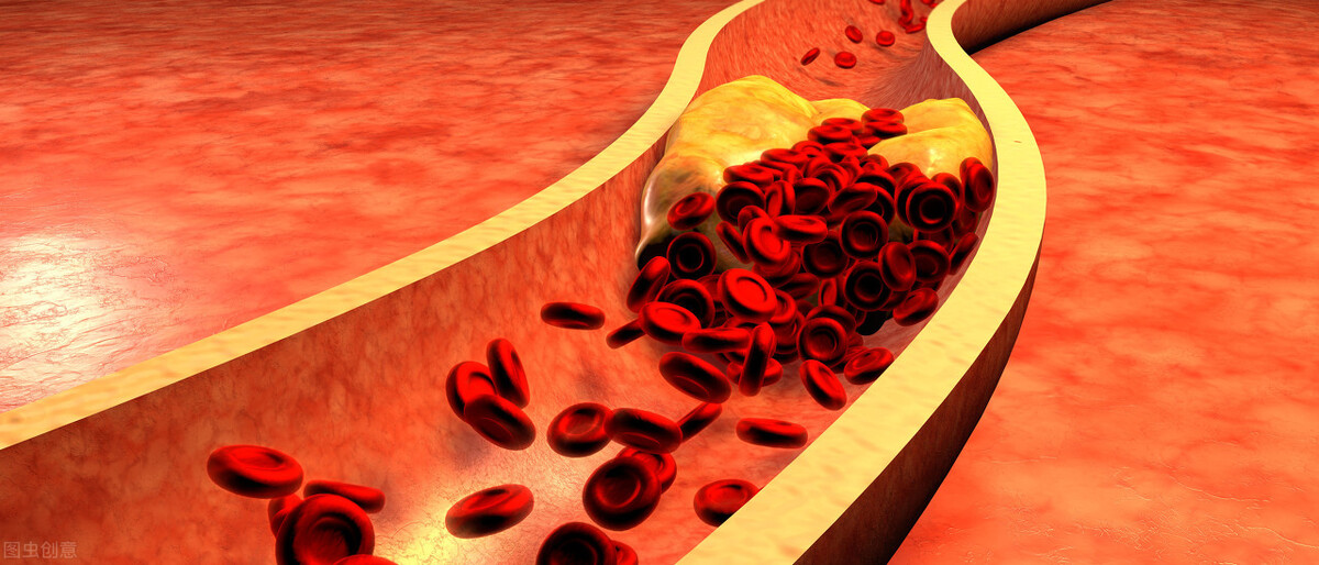 高低密度脂蛋白高怎么降下来(血脂异常的危害：如何处理升高的甘油三酯和低密度脂蛋白胆固醇？)