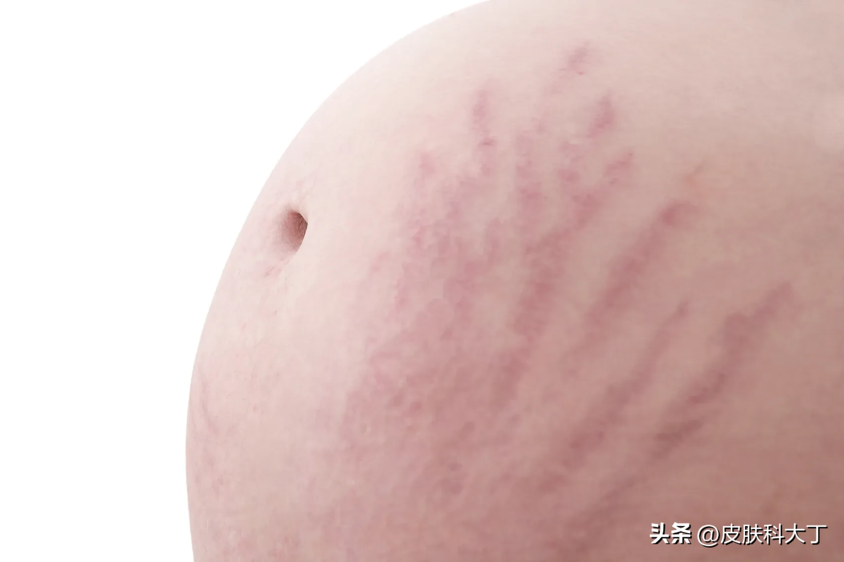 老婆肚子妊娠纹像蜈蚣(妻子孕肚长满了妊娠纹，像被蜈蚣爬满，贵州一男子称太恐怖了,震)