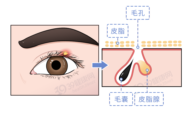 长了麦粒肿，怎么治疗好得快？一定要开刀吗？这几件事要记住