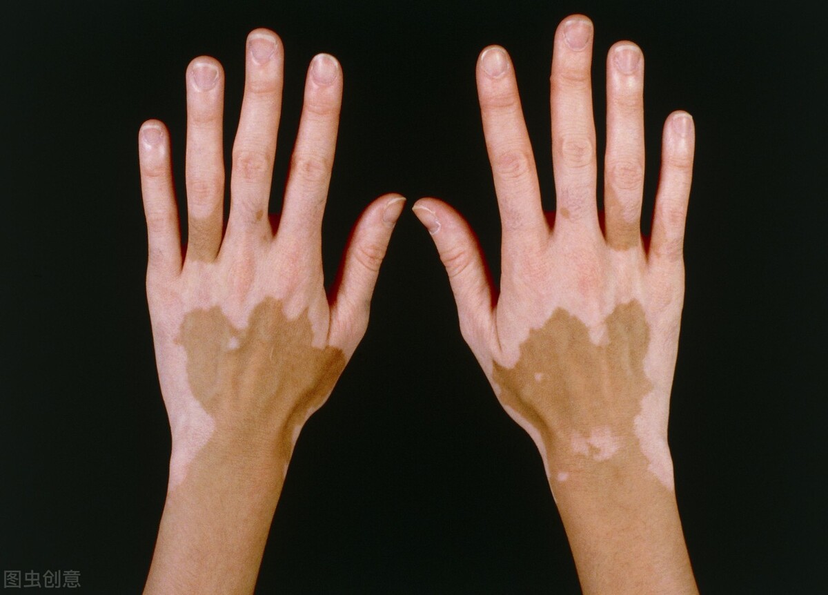 各种皮炎湿疹类皮肤病,浅表真菌感染,炎症性皮肤疾病,先天性的白斑