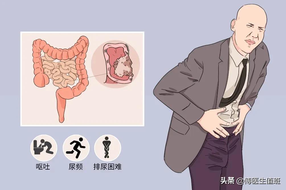 男子腰背部疼痛，就医发现腹腔占位，手术中护士惊呼：太少见了