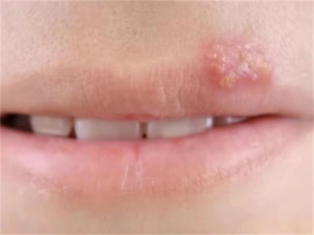 女大学生朱力亚感染艾滋病的故事