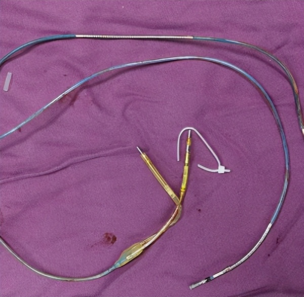 仁医病例丨成功拔除植入9年的除颤电极